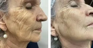 HIFU facial: arquitectura biológica para redefinir el rostro